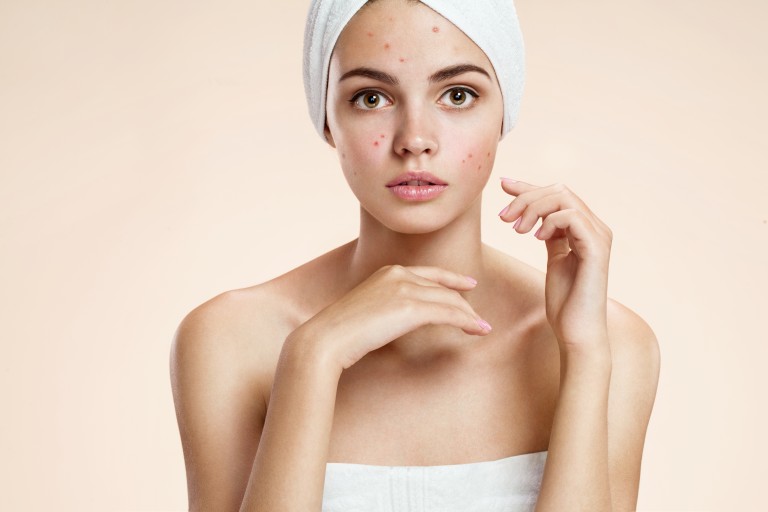 produits-traiter-acne-une