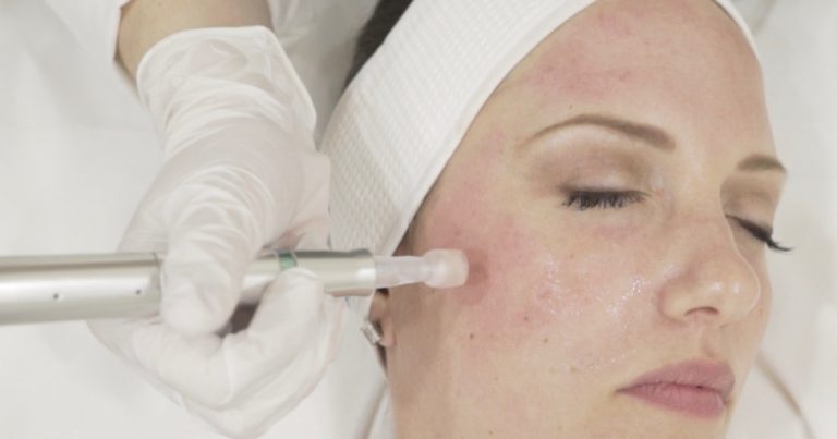On a testé pour vous : le microneedling