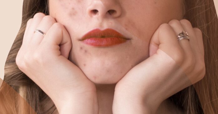 acne adulte
